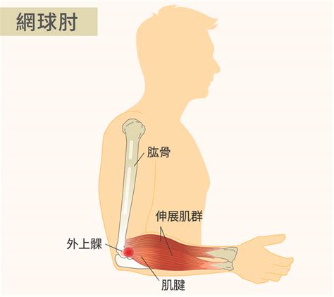 中指受傷|手肘痛、手腕痛、手指痛的原因,治療與自我檢查 » 台。